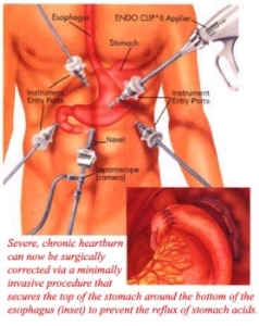 Laparoscopic Anti-Reflux Surgery for 'Heartburn' 
